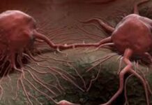 جان لیوا مرض کینسر سے بچاؤ کے طریقے